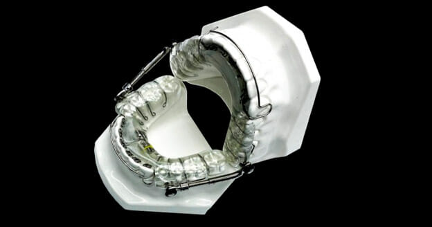A 3D dental appliance designed to improve jaw alignment, shown on a model of upper and lower teeth