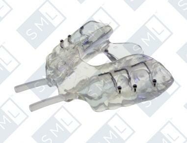 A clear dental appliance with tubes and metal fasteners used for sleep apnea or airway treatment