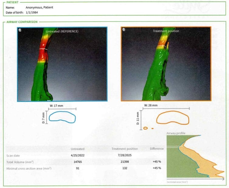 A medical report compares untreated and treated 3D airway scans, showing a 45% increase in volume and minimal cross-sectional area